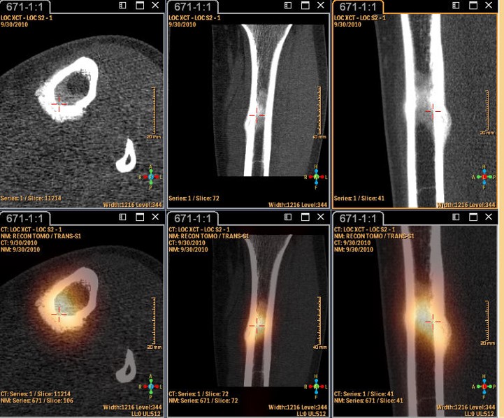 Western Nuclear Medicine BONE Scan (SPECT/CT)